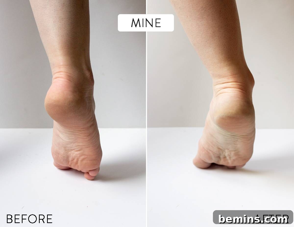 Do Pinterest Beauty Hacks Really Deliver? 22 Before and after: Listerine foot soak